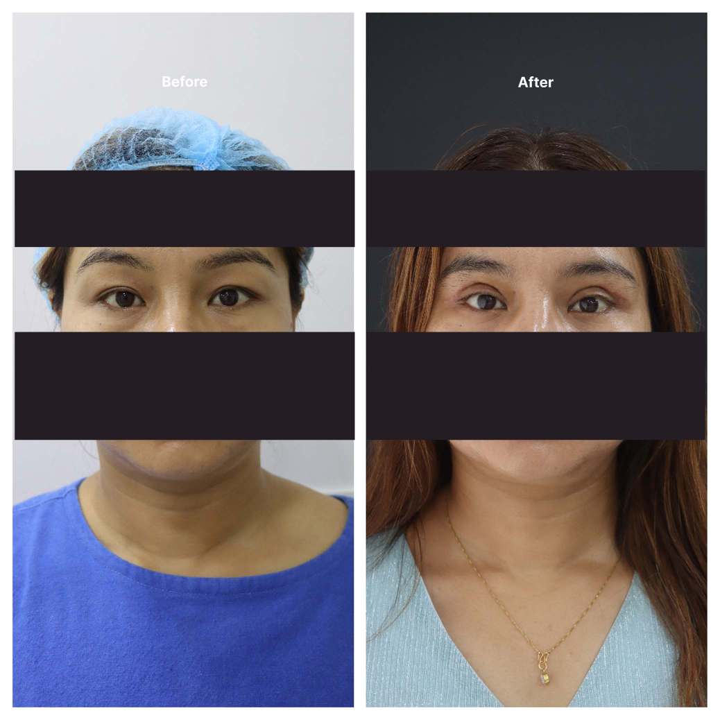 Eyelid Surgery KOQ10